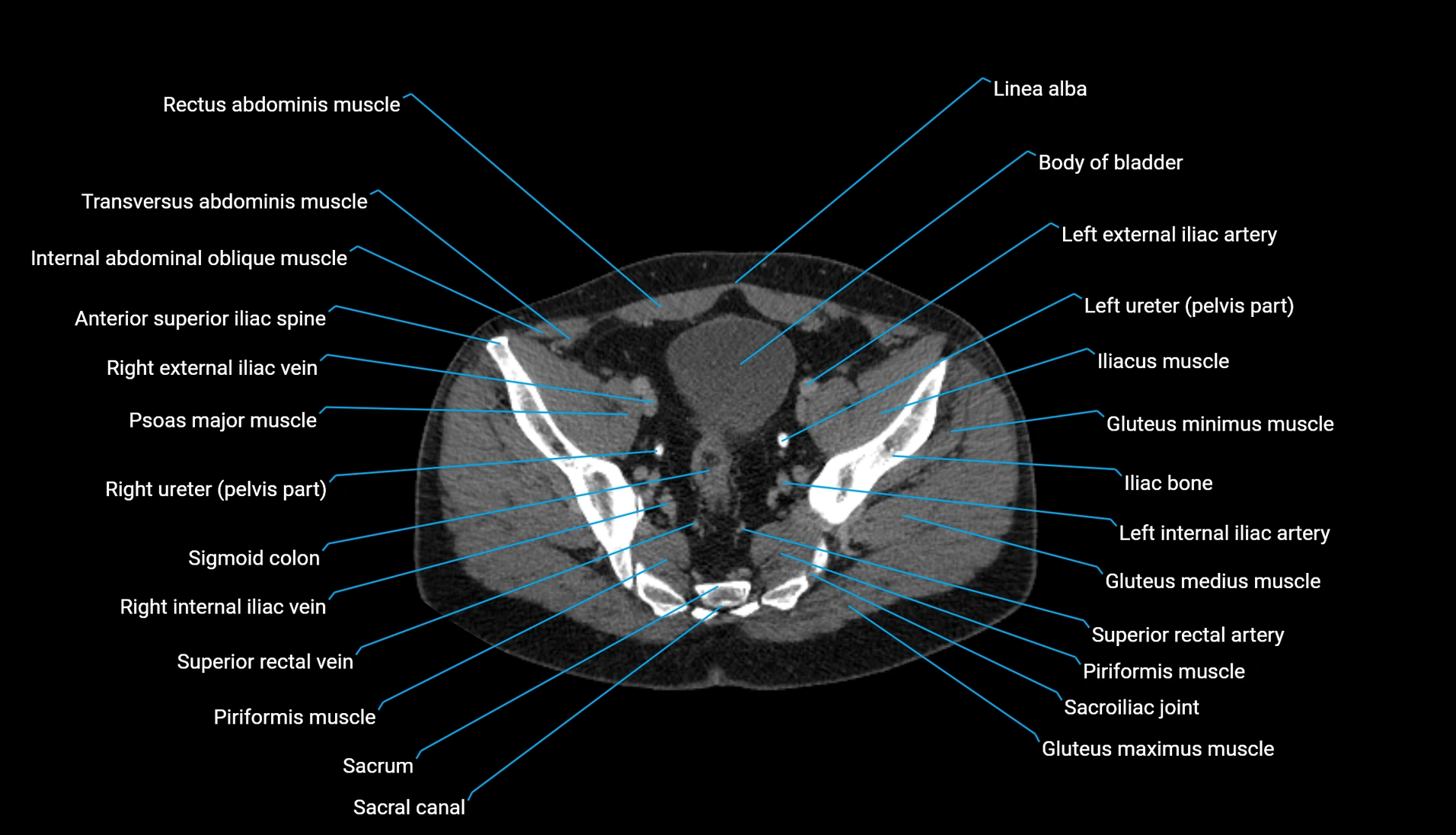 CT urogram axial cross sectional anatomy  labelled radiology image-00202.webp